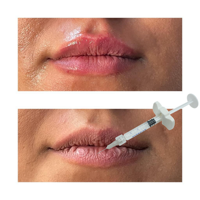 De niet Chirurgische Injecties van de de Vullers Hyaluronic Zure Lip van de Lippenverhoging