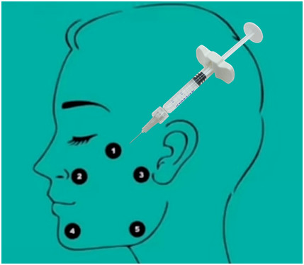 Dwars Verbonden Hyaluronic Zuur de Vuller Hyaluronic Zuur Gel van 32mg h-Ha l-Ha niet