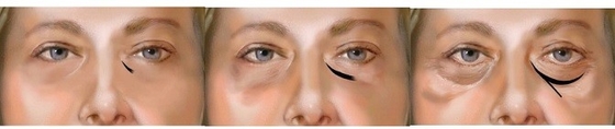 verwijdert de Injecteerbare Hyaluronic Zure Oplossing van 1ml 2ml Behandeling van Ogen de Donkere Cirkels