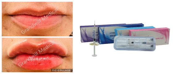 Hyaluronzuur Dermale Filler voor injectie 1 ml 2 ml 3 ml 5 ml 10 ml 20 ml 50 ml Voor Borst Achterbuik Lichaam