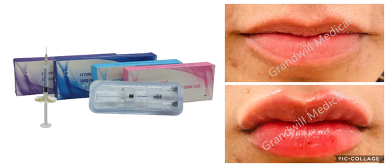 5 ml Lip Filler Hyaluronzuur Injectie Gel Filler Fles Spuit Pakket Gezichtsrimpels Behandeling