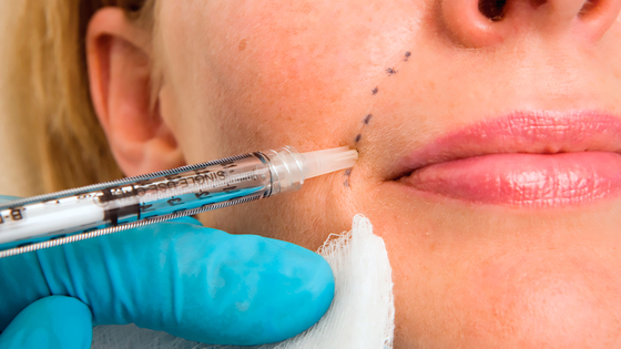 50 ml injecteerbare hyaluronzuur Dermale Gezichtsfiller met lidocaïne PCL Plla Filler Injectie