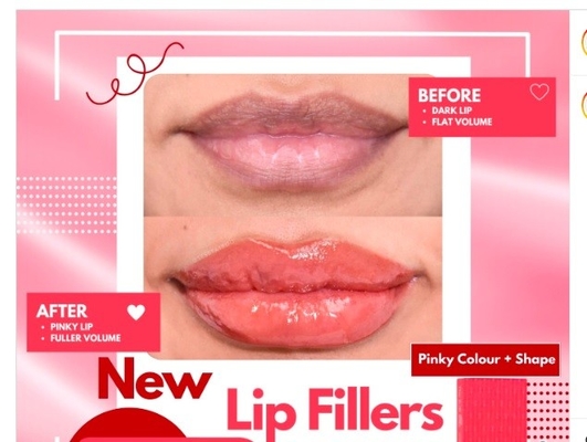Effectieve huidfillers voor lippen Hyaluronzuur lippen injecties voor de vergroting van de rode lip