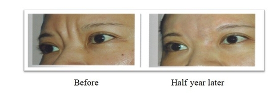 350 mg 150 mg PLLA Poly L Lactic Acid Dermal Filler voor de behandeling van gezichtsrimpels