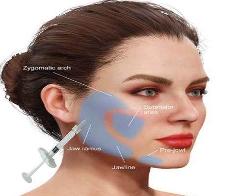 Hyaluronzuur HA Calcium Hydroxyapatite Filler krijg een natuurlijk gezicht met 1 ml spuit