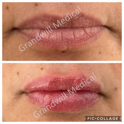Injecteerbare Hyaluronic Zure het Gel Huidvuller 1ml 2ml van de lippenvergroting