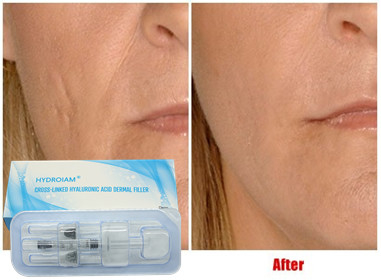Hyaluronic Zure Injecteerbare Vuller 10ml voor de Wangen Chin Augmentation van de Lippeninjectie