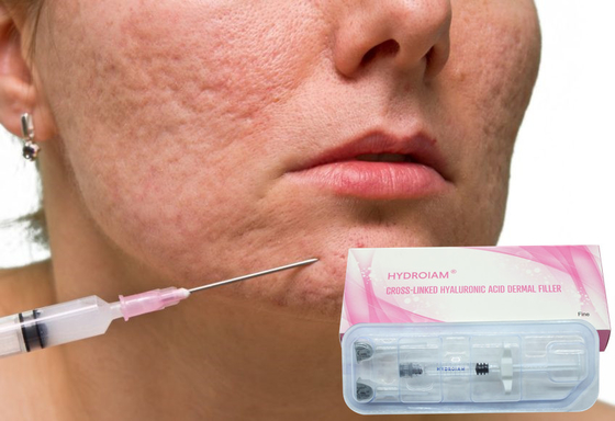 1ml het Gelinjectie van natriumhyaluronate voor het Verwijderen van Fijne Gezichtsrimpels