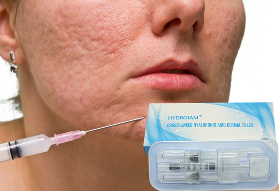 10ml injecteerbare Hyaluronic Zure Huidvuller voor het Verbeteren van Gezichtsasymmetrie