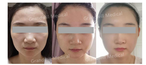 Hyaluronic Zure PCL-Aanraking van het Huid Hulpmirakel op de Stimulator van het Huidcollageen