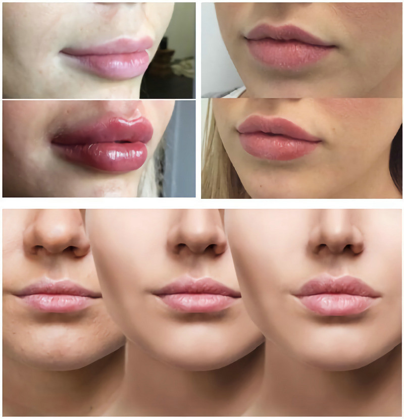 Vlotte Lijnen/Mollige Lippen met Hyaluronic Zure Injecteerbare Vuller 1ml 2ml 5ml