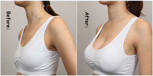 Injecteerbare hyaluronzuur Ha Filler voor lippen Gezichtsrimpel Borstvergroting bilfiller injecties