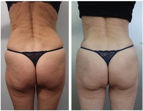Goedkope Prijs 50ml Body Filler Hyaluronzuur Injectie Gel Fles Verpakking Borstvergroting Bilvergroting
