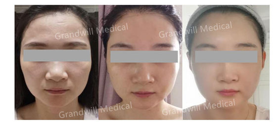 Steriele, cross-linked hyaluronzuur dermale filler ontworpen voor natuurlijk ogende gezichtscontouring en huidverjonging
